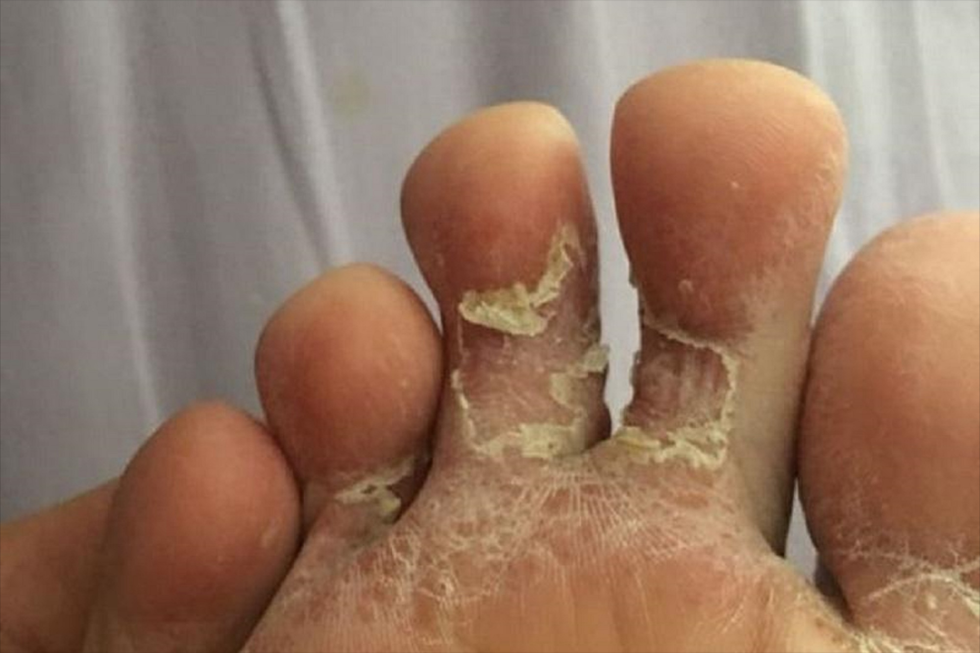 没想到5年脚气一个月搞定每天成本几毛钱错过掐大腿