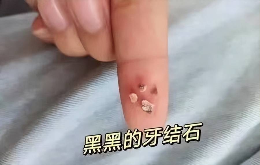 牙齿上黄厚牙结石怎么办过来人的方法一针见血牙石哗哗掉