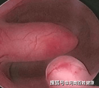 容易导致不孕/流产等多肉植物一样子宫内膜息肉就像我们看到的考虑