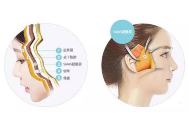 筋膜悬吊面部提升术怎么做?看完了你还敢做吗?