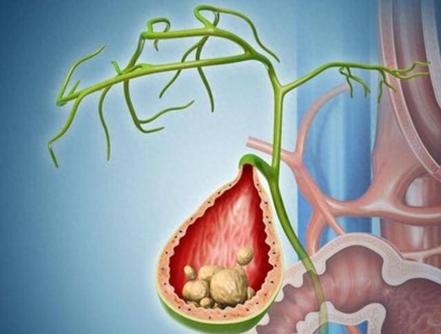 不痛的胆结石才是沉默的杀手