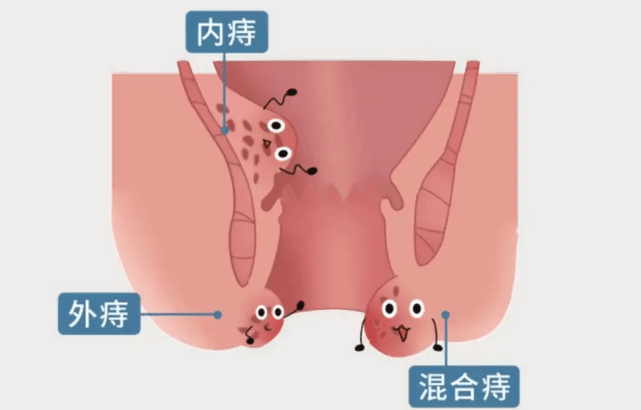 内痔疮 男人图片