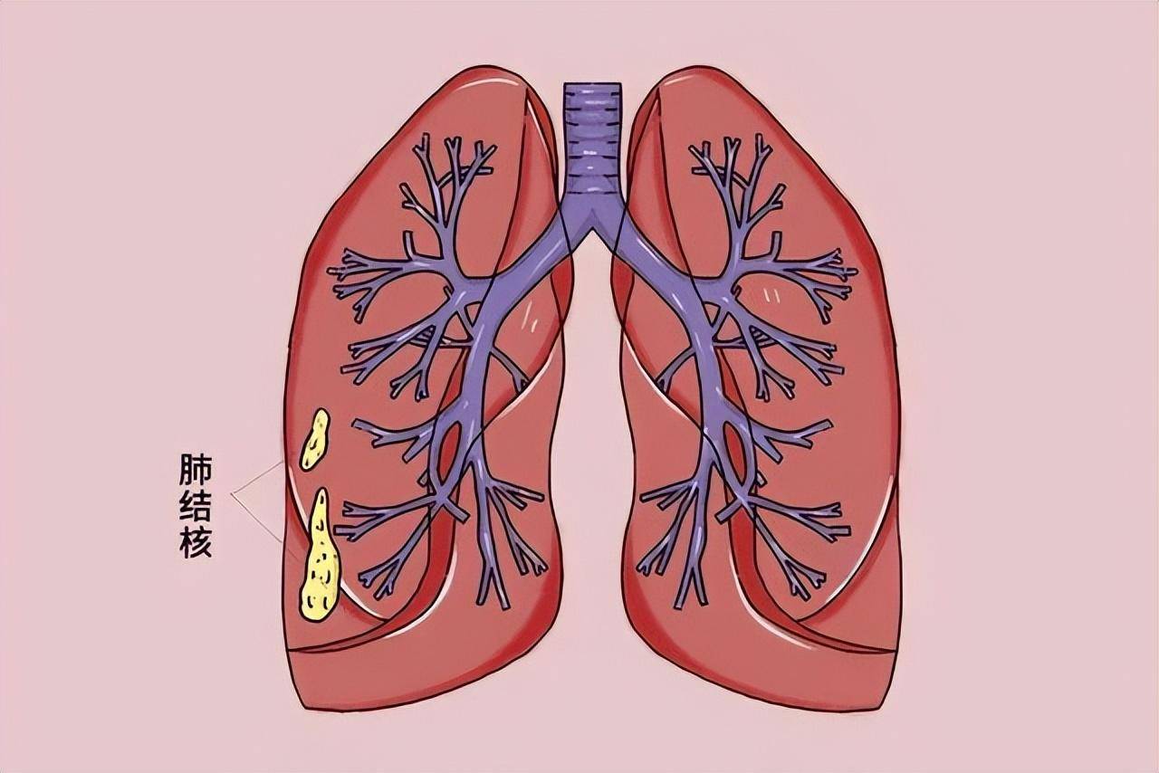 肺结核有什么症状图片