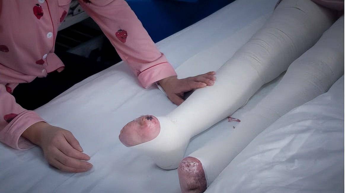 原创2019年一16岁少女火海救弟弟被毁容弟弟没人要你我娶你