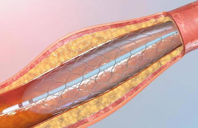 原创国内将逐渐停止心脏支架手术做完人就废了医生道出真相