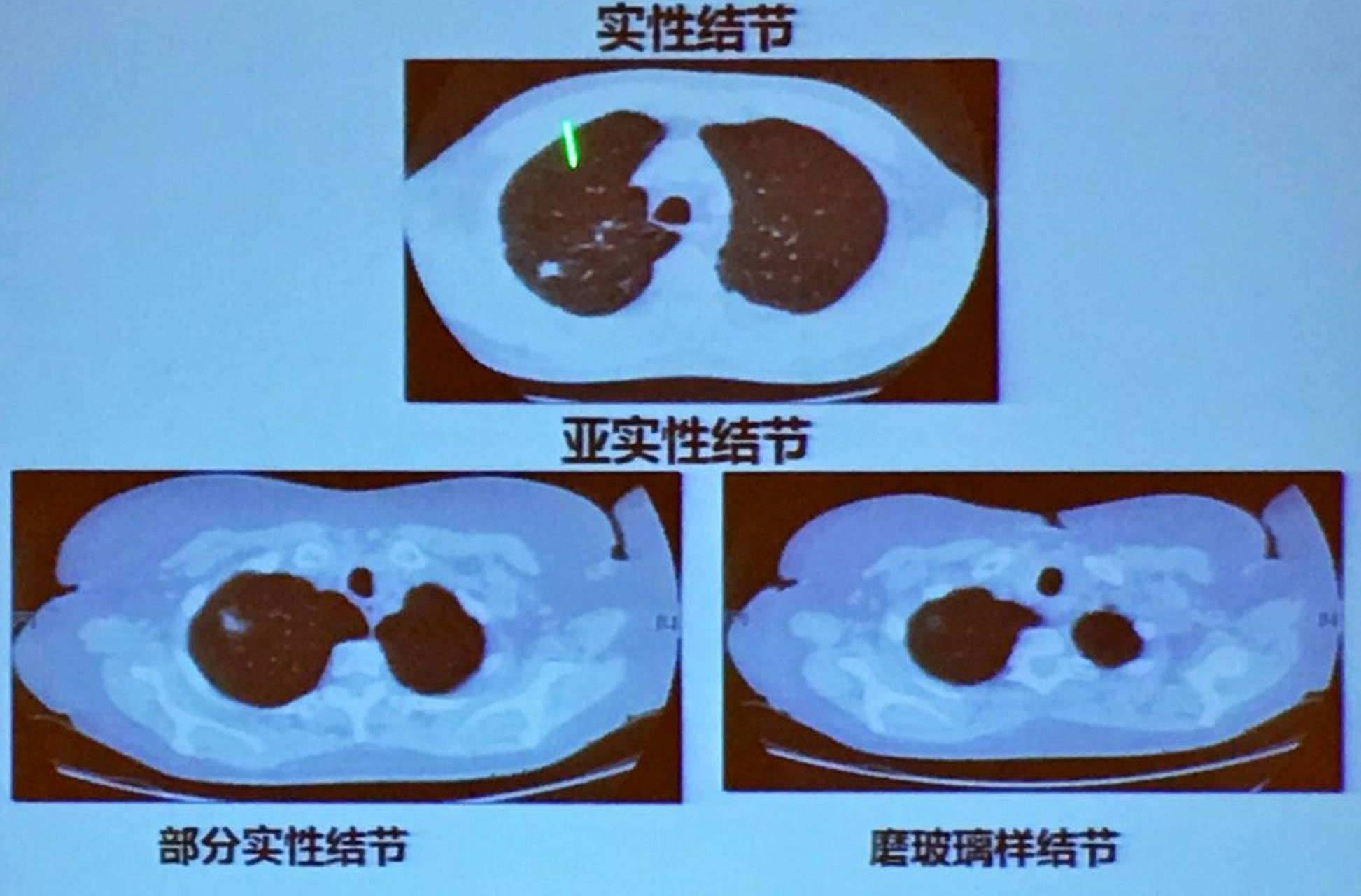 小叶中心结节示意图图片