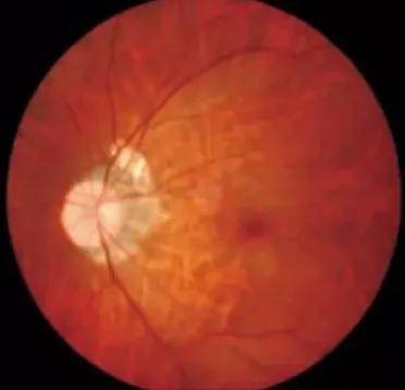 科普丨高度近视≠病理性近视!你属于哪种近视?_病变_患者_眼底