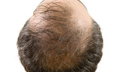 原创脱发迅速蔓延到90后这么做避免脱发