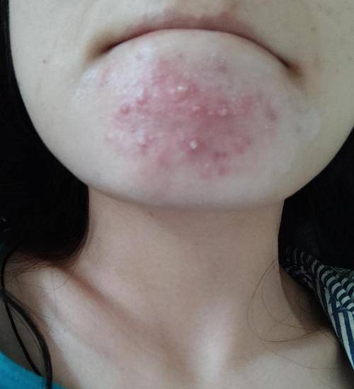 eir祛痘霜拯救我的下巴痘痘