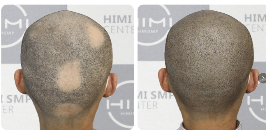 由免疫类疾病或基因问题引起的斑秃,通用上诉的治疗方法治愈率低又慢