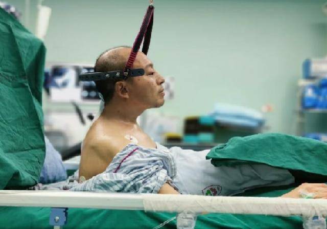 原创身体折叠28年历经四次艰难手术折叠人李华终重获新生