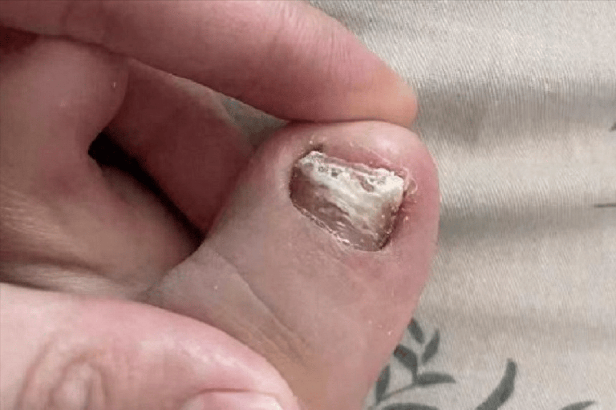 灰指甲反复发作好不了自用祛灰妙招分享居家一次性根除不复发