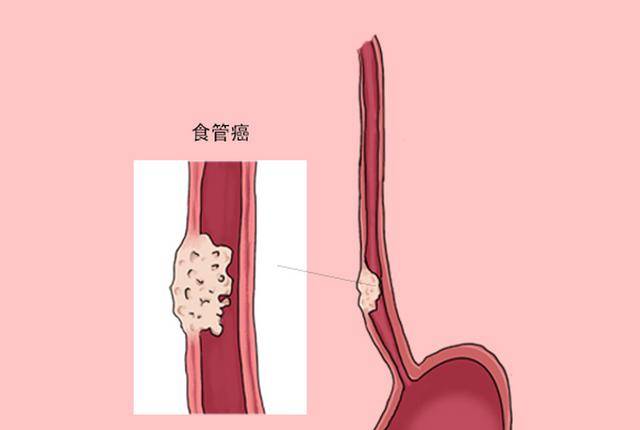 食道癌,多数人误以为是咽炎?医生:这两个症状,切莫混淆