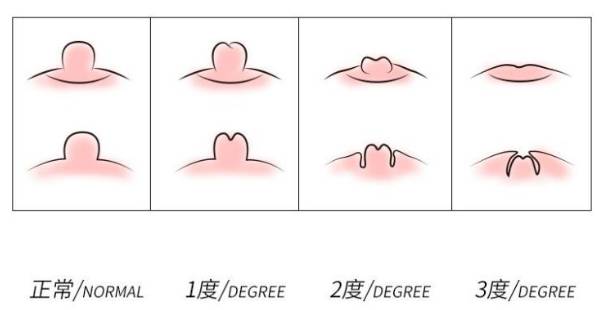 乳腺皮肤凹陷图早期图片