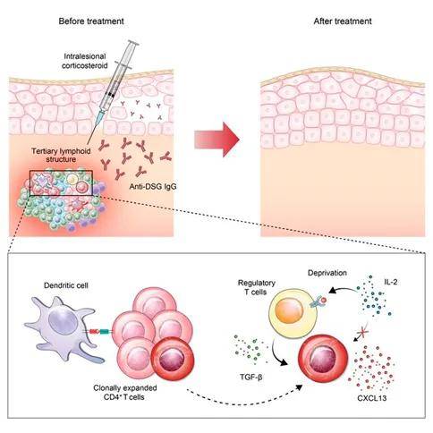 靶向dsg1/3(桥粒芯蛋白)的自身反应性b细胞介导的罕见自身免疫性疾病