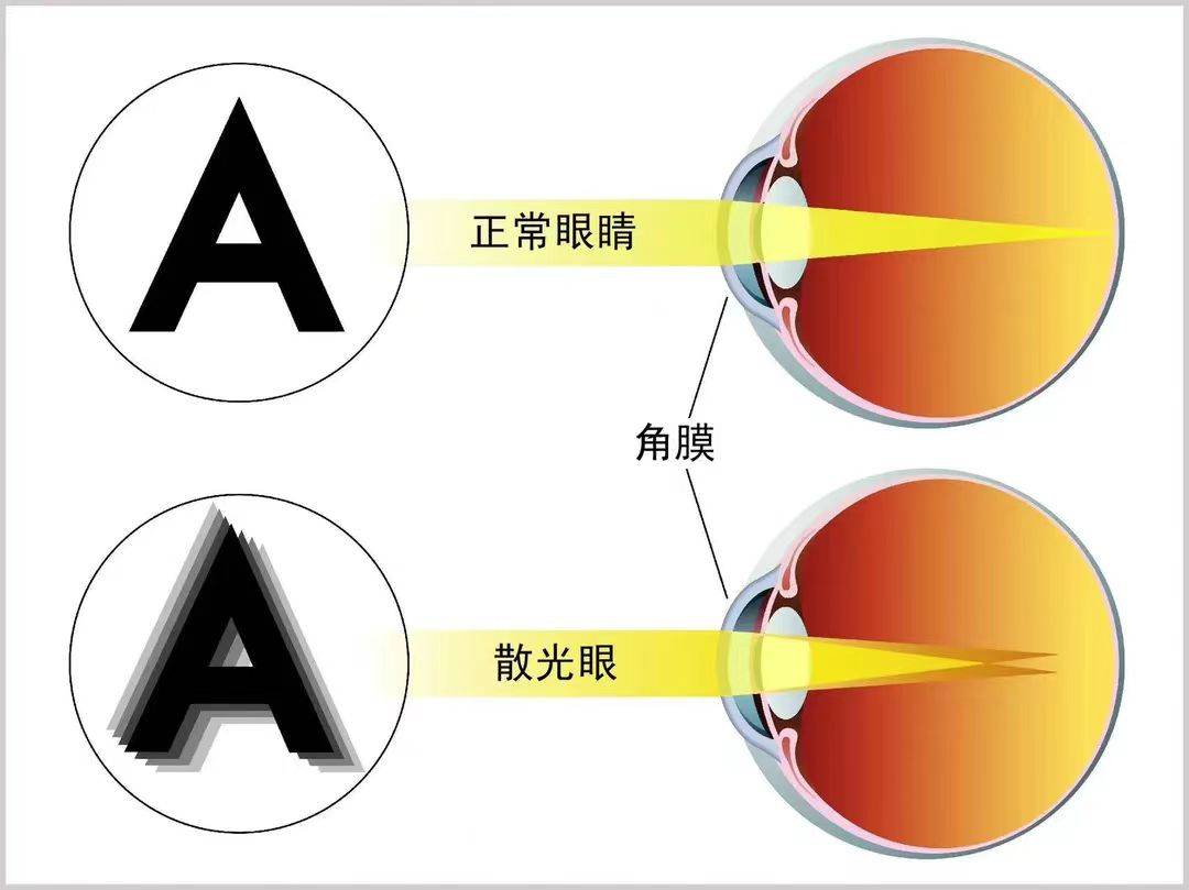 重庆眼科专家汪红:眼睛看不清?不一定是近视,也可能是散光