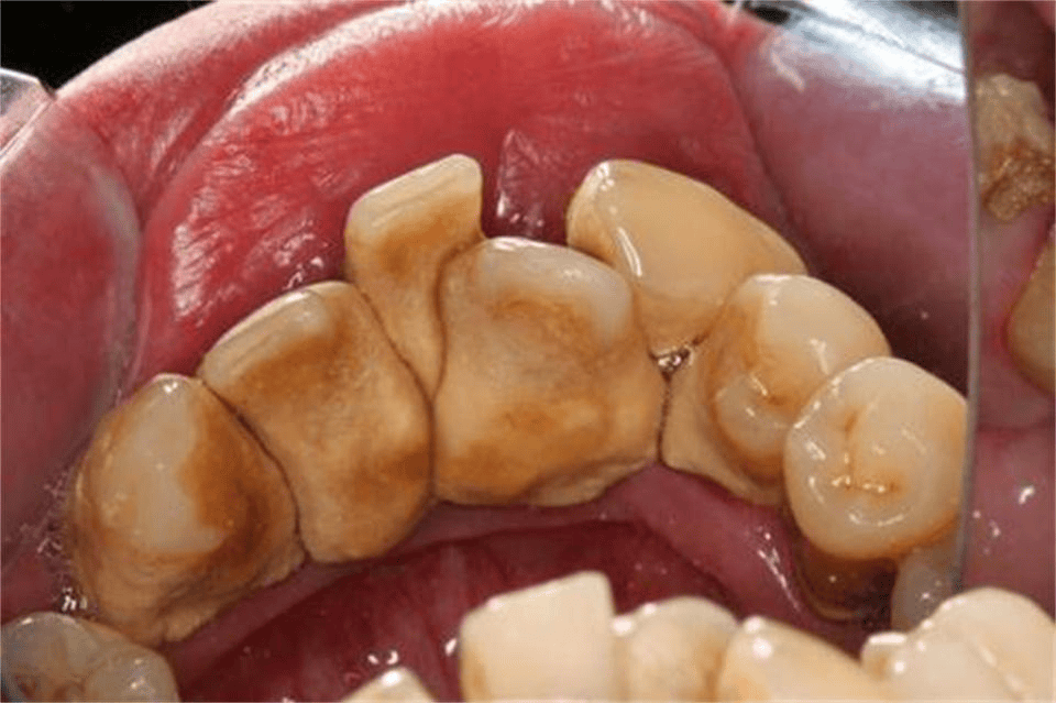 傻瓜式去除牙结石方法现在公开学会牙石咔咔掉