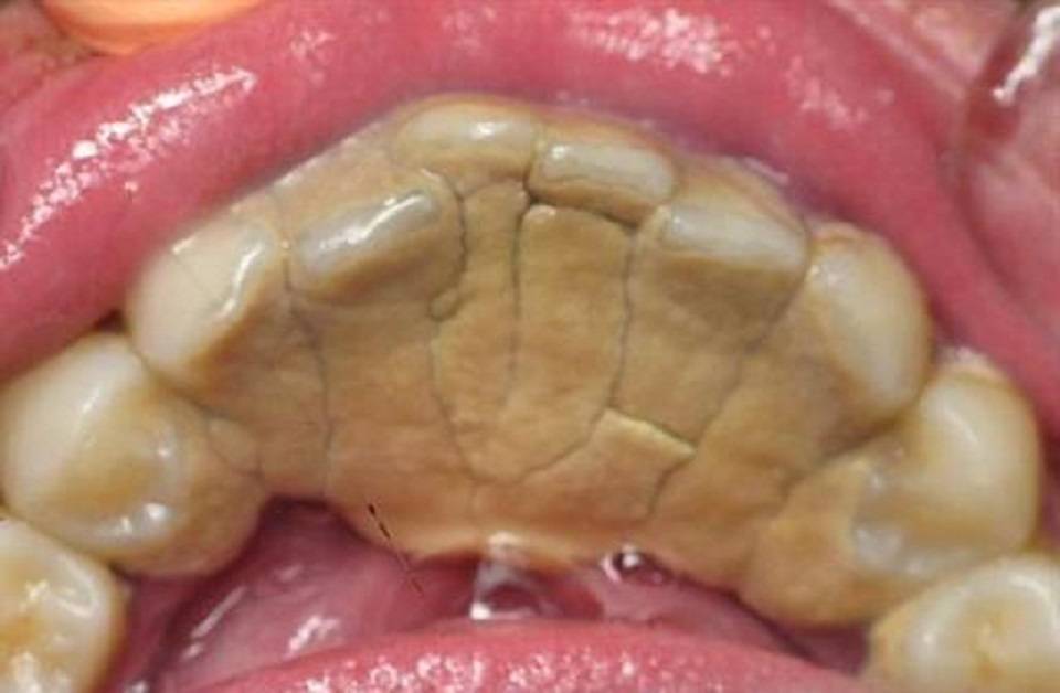 黑臭的牙结石就别乱用方法了过来人支你三招牙石不掉都不行