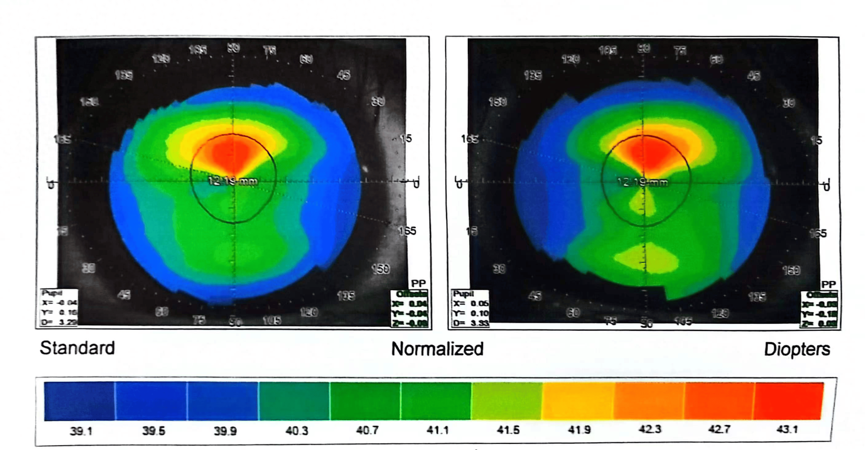 在排除晶体,眼底相关问题后,张小红主任建议做角膜地形图检查.