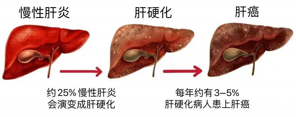 慢性乙肝是如何发展的带你揭秘其4大发展阶段