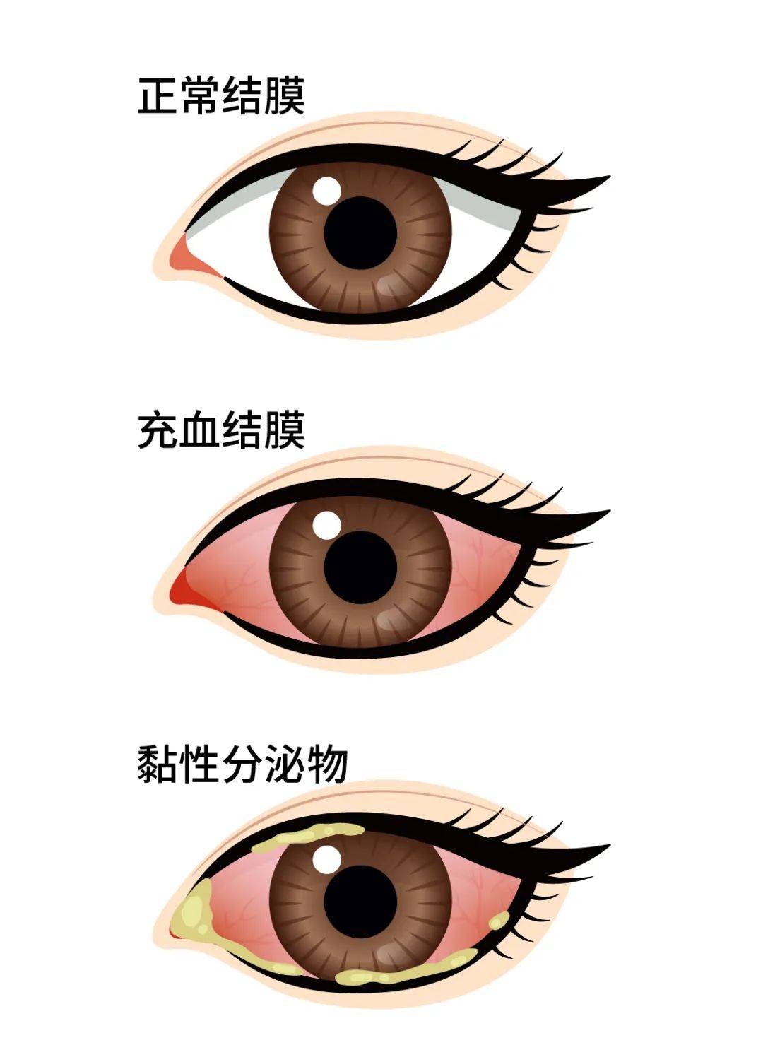 "红眼病"潜伏期短,一般为12-48小时,发病开始时多为单眼,很快传染到另