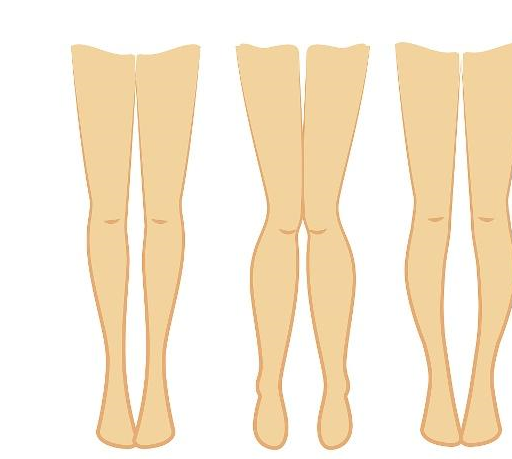 原创有这3个共同点的人多半都存在罗圈腿4种矫正法可以尝试