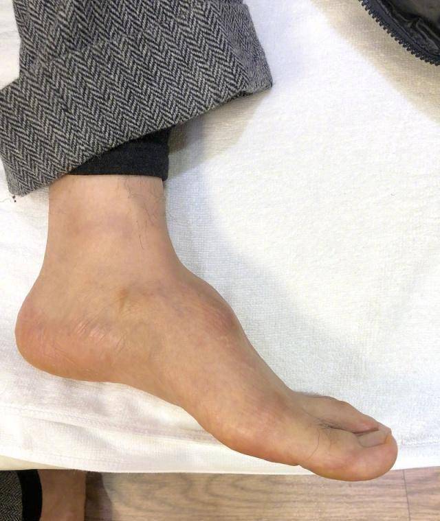原创被指身高180cm是垫了增高鞋垫黄晓明晒脚背照回应脚受过伤
