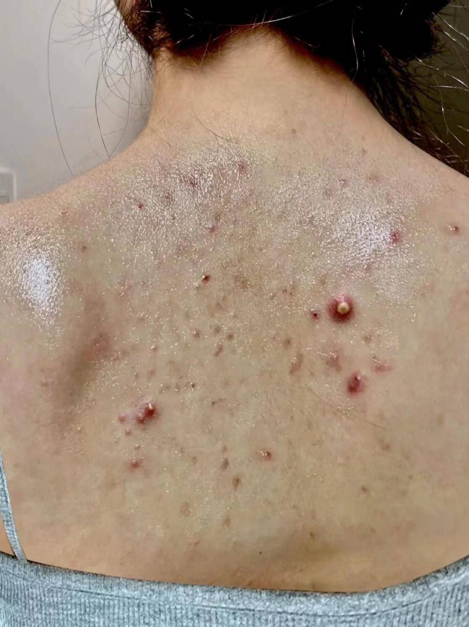 后背爆痘瘙痒不要怕过来人教你几招低成本高效去螨痘