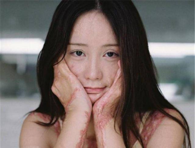 原创安徽16岁少女周岩因拒绝官二代追求被泼汽油毁容如今怎样