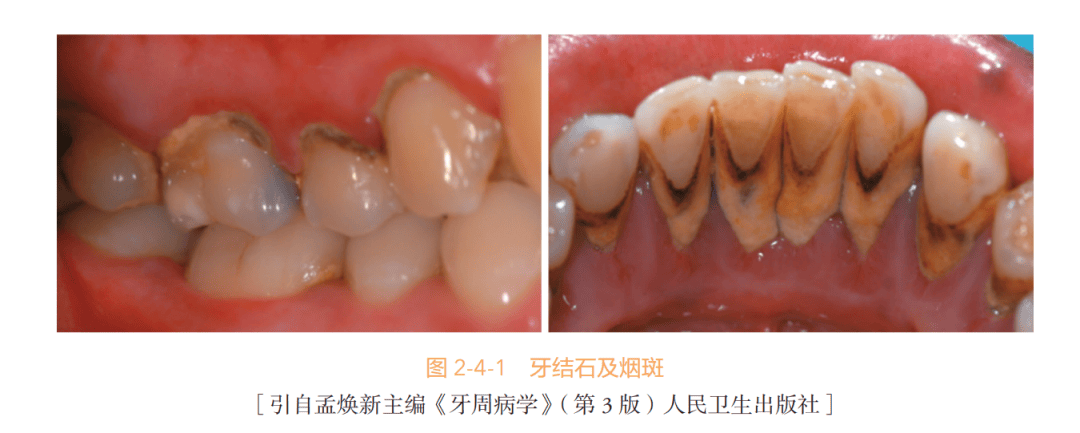 龈下刮治前后对比照片图片