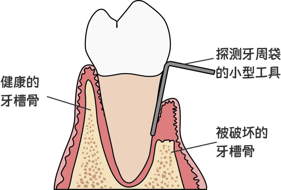 牙周袋冲洗步骤图片