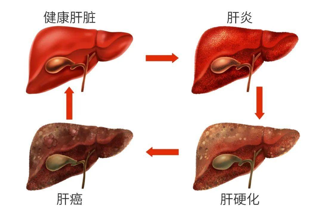 爱喝酒的人,身体出现这5种变化,可能是肝癌"信号"_手术_肝脏_张成武