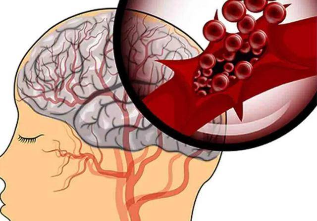 血压多高,会发生"脑出血"?医生坦言:最好不要超出"这个数"