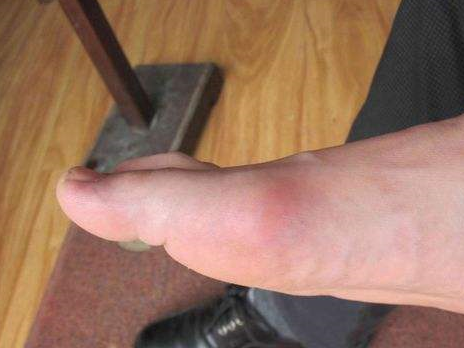 吃什么食物能远离痛风?送你一张嘌呤含量图,照着吃准没错!