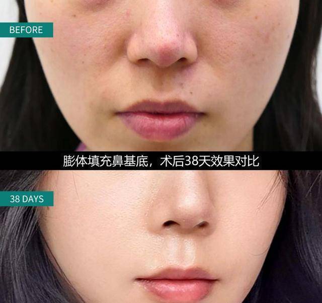 春节到来之前,想变漂亮?建议尝试这3种医美项目,持久,又安全