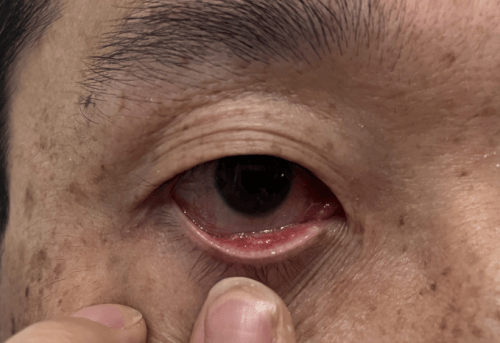 外出踏青后视力下降,竟然是过敏性结膜炎惹的祸_熊先生_徐静_眼睛