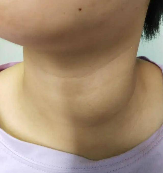 甲状腺结节脖子照片图片