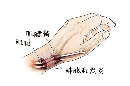 尺侧腕伸肌腱鞘炎图片