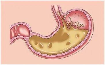 胆汁反流性胃炎有4大症状1腹痛,腹