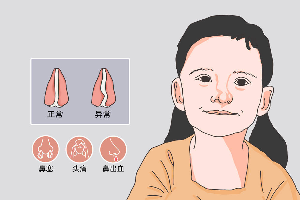 鼻炎不仅是鼻塞和喷嚏