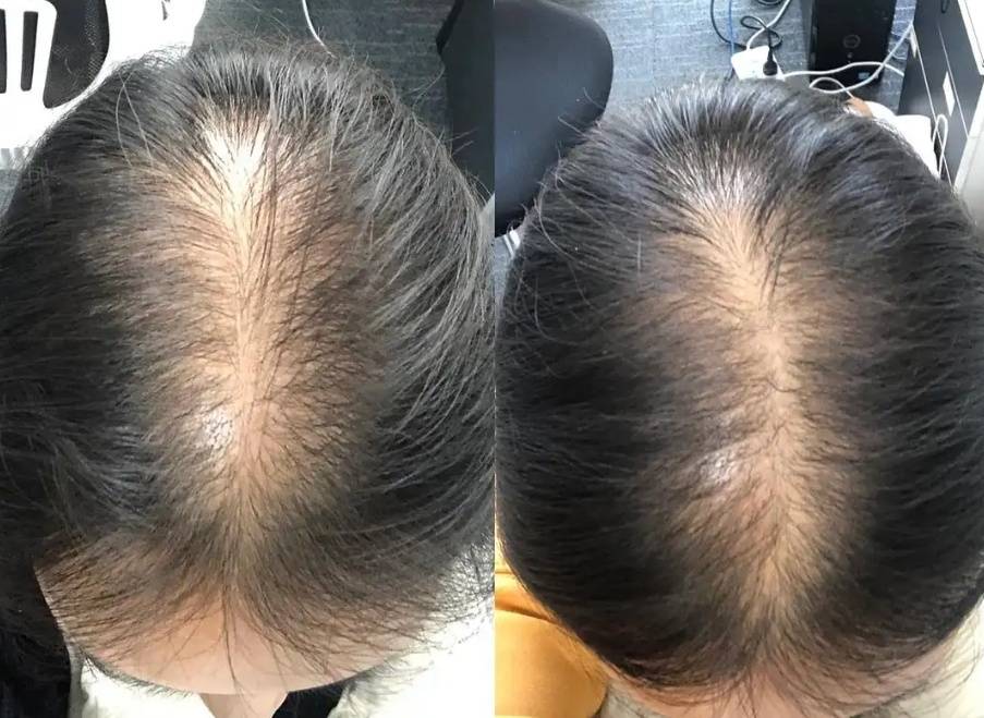 提前参考哪种洗发水防脱发增发密发