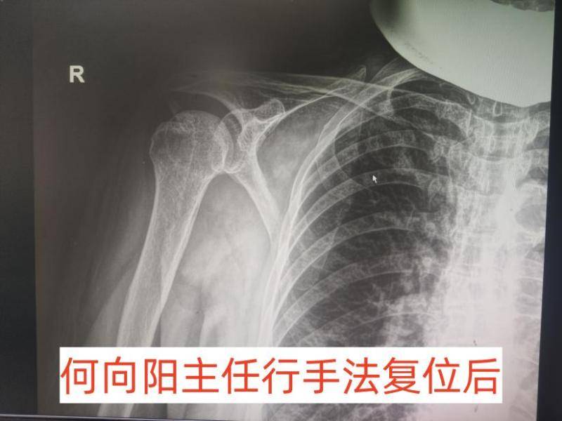 福德医院骨质疏松专家何向阳主任成功为七旬骨质疏松老人复位肩关节