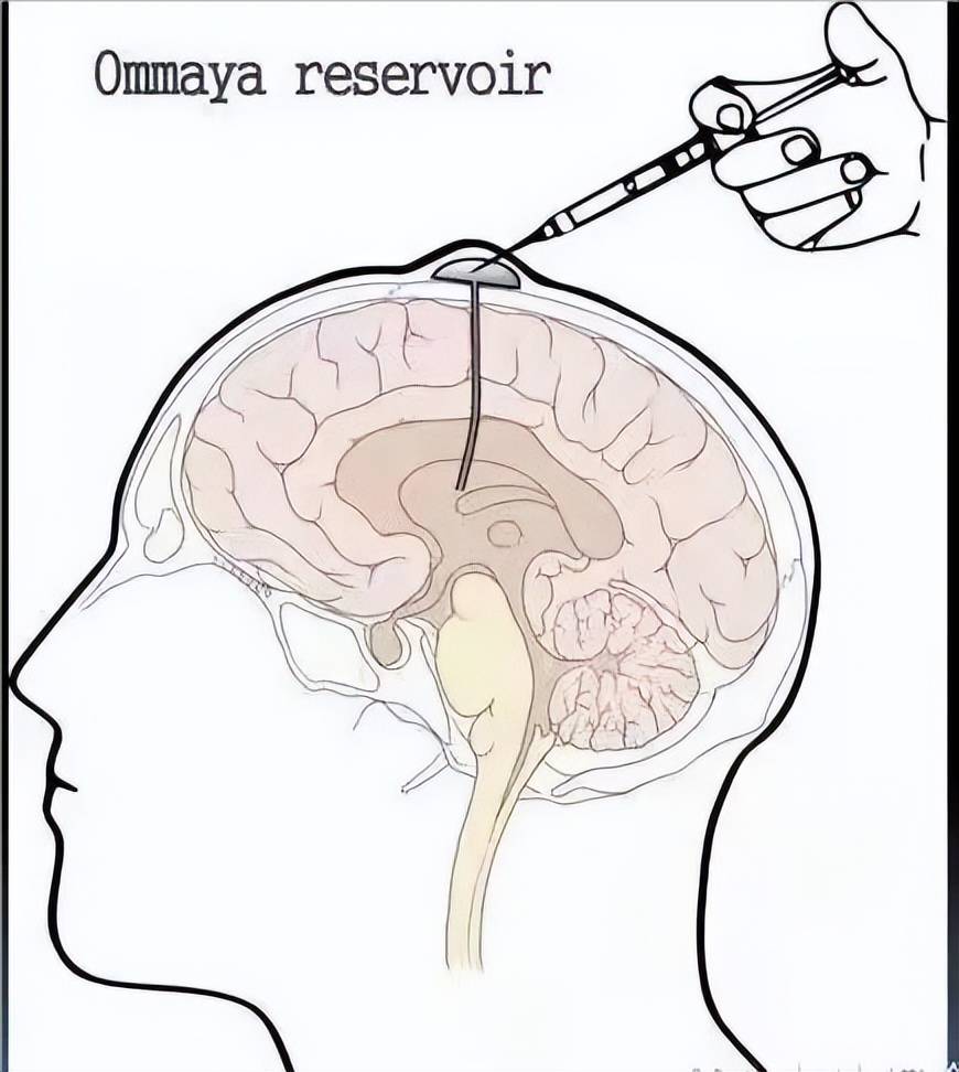 脑脊液引流术图片图片