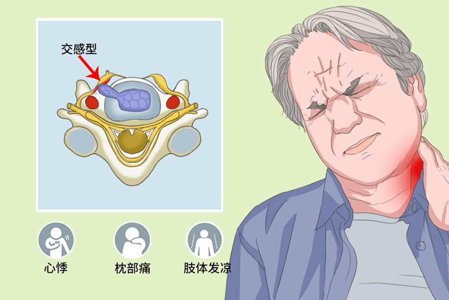 交感型颈椎病的都有什么症状?解析全部症状和恢复方法