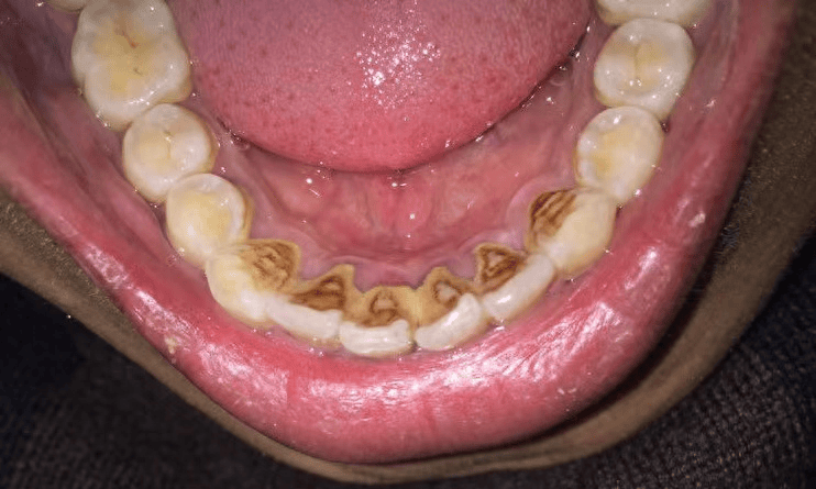 牙结石唰唰唰全掉,真后悔没早点知道!_牙粉_牙齿_效果