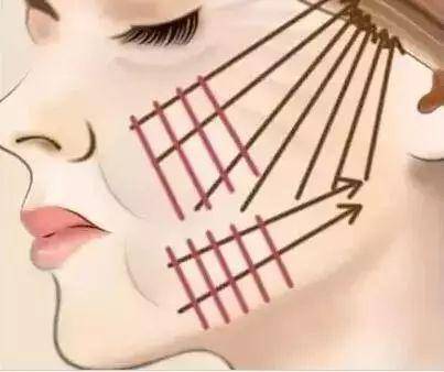 做线雕提升脸部好不好,线雕面部提升能保持多长时间?有答案