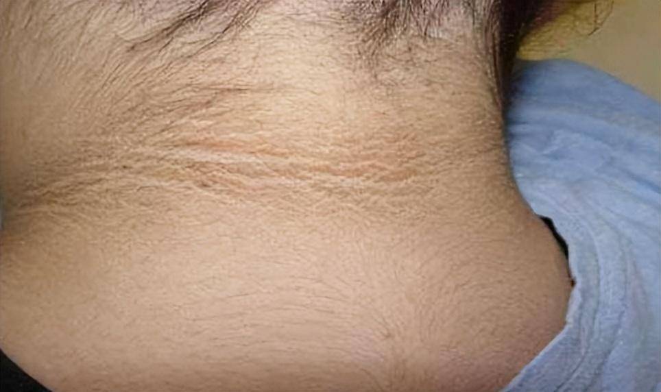 脖子,腋窝长这2个东西,提示你可能得了糖尿病,赶紧对照看