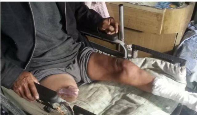 2012年,河北农民因拿不出60万手术费,锯掉自己的右腿,结局如何