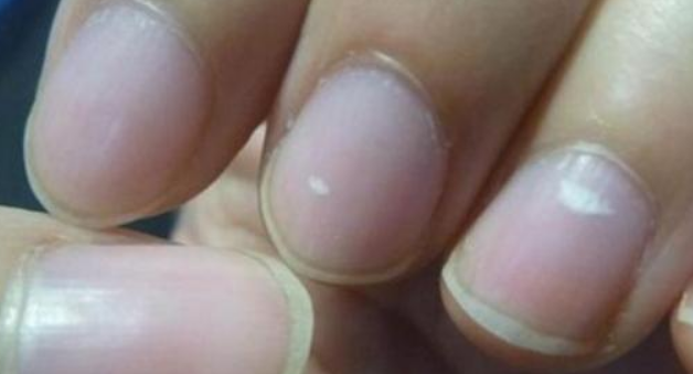 但若是你发现自己这段时间中指指甲泛白,一点血色都没有,而且上面隐隐