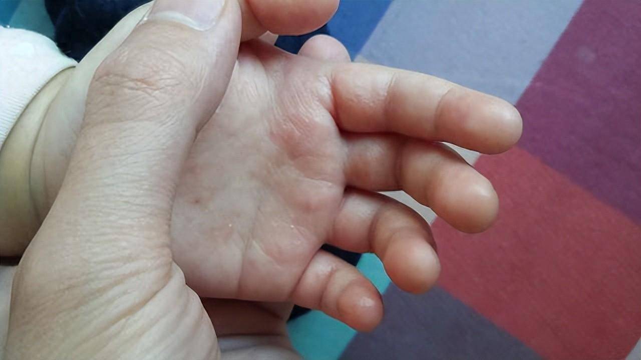 婴儿的手掌又红又热。是不是有病？什么情况下应该去看医生？_父母_子女_其他
